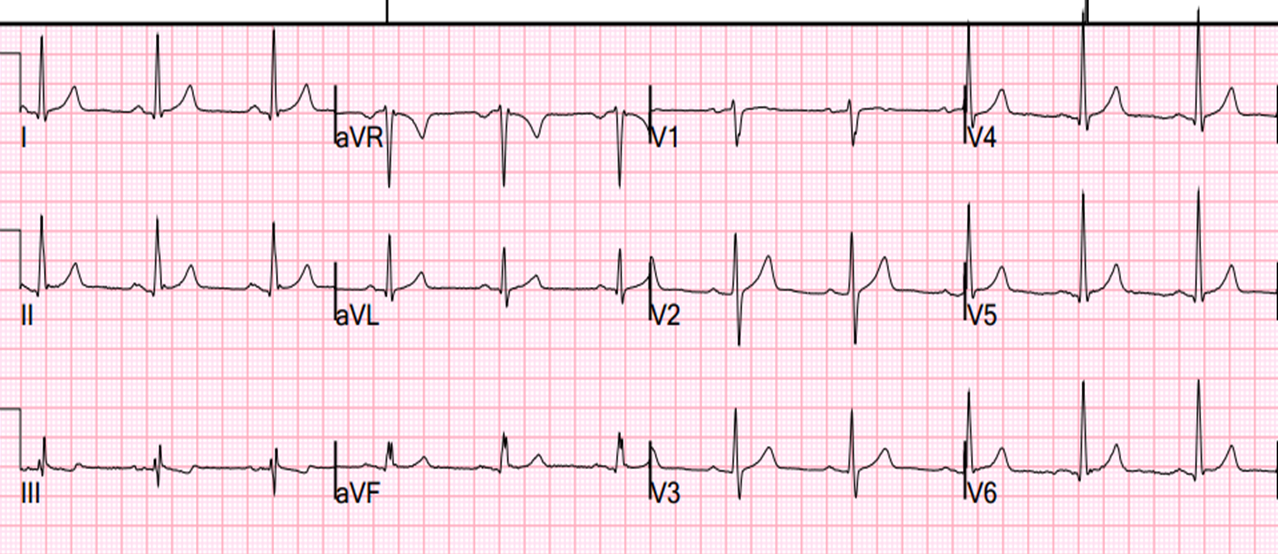 ekg